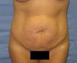 Abdominoplasty Before & After Image