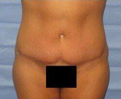 Abdominoplasty Before & After Image