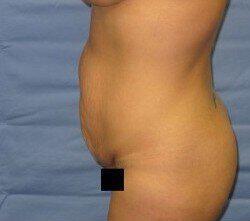 Abdominoplasty Before & After Image