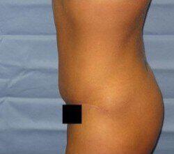 Abdominoplasty Before & After Image