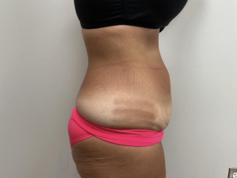Abdominoplasty Before & After Image