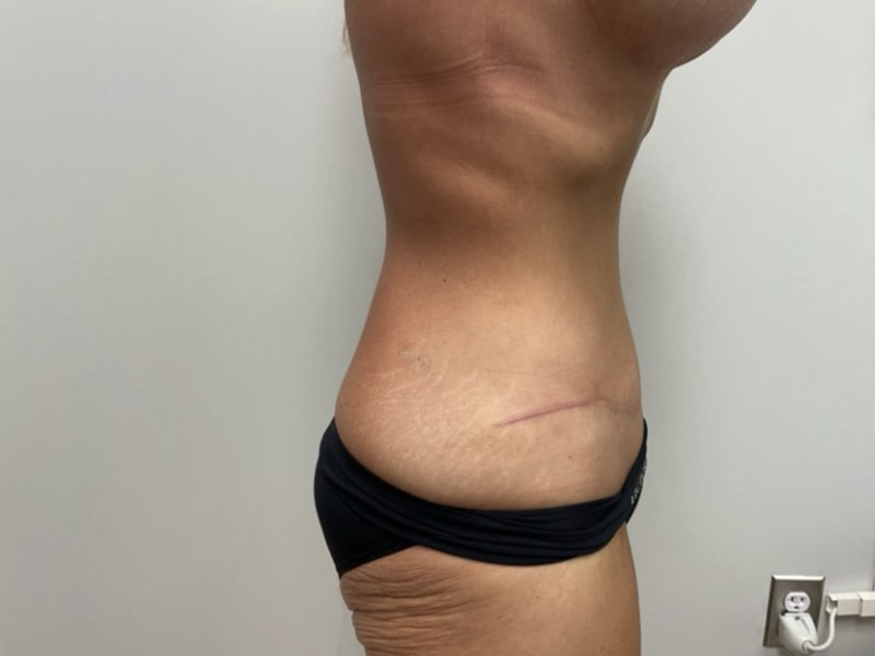 Abdominoplasty Before & After Image
