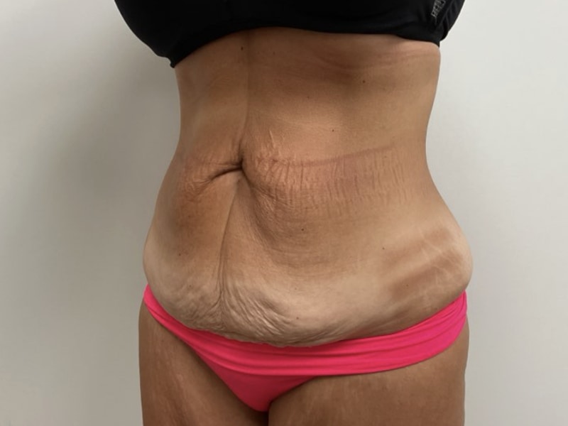 Abdominoplasty Before & After Image