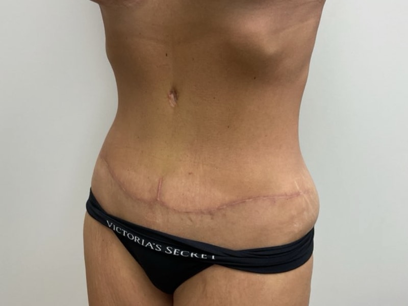 Abdominoplasty Before & After Image