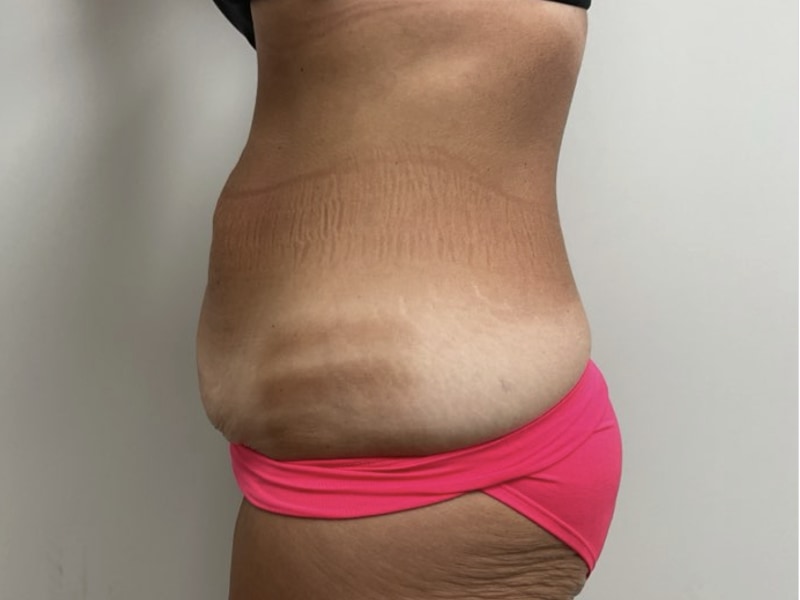 Abdominoplasty Before & After Image