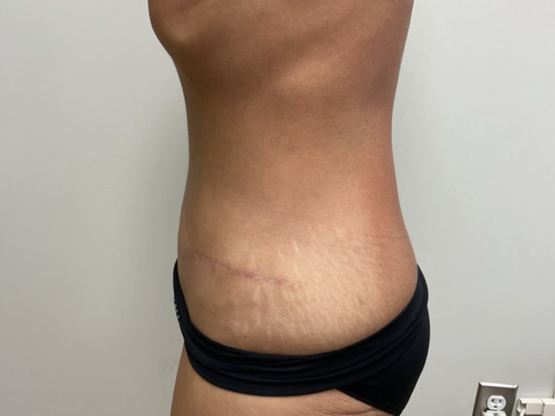 Abdominoplasty Before & After Image