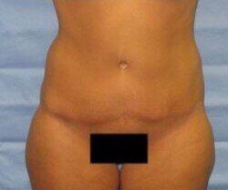 Abdominoplasty Before & After Image