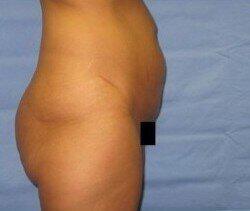 Abdominoplasty Before & After Image