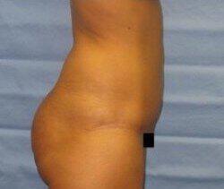 Abdominoplasty Before & After Image