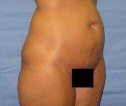 Abdominoplasty Before & After Image