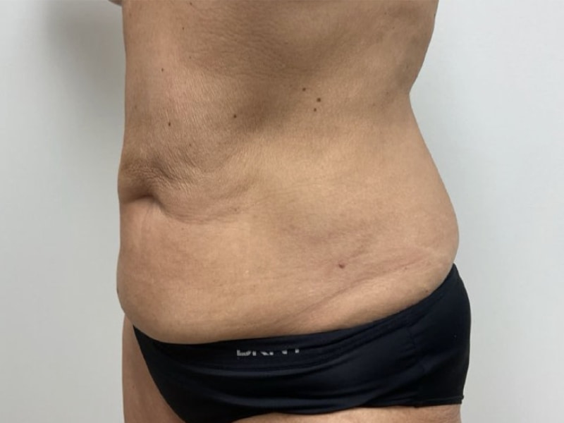 Abdominoplasty Before & After Image