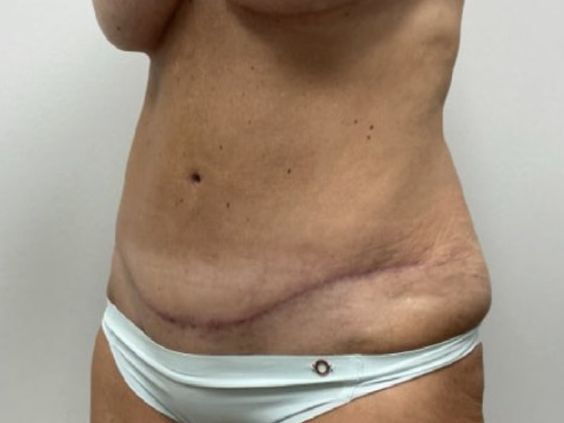Abdominoplasty Before & After Image