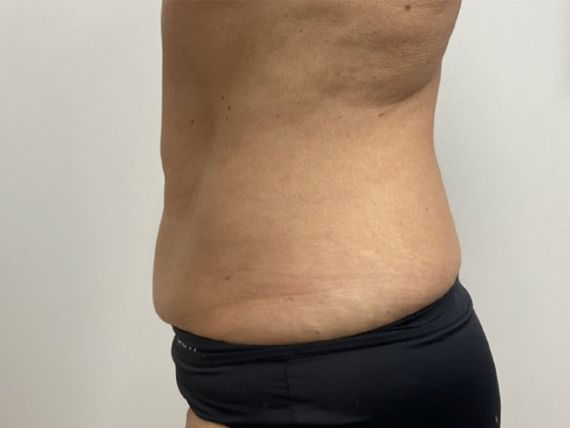 Abdominoplasty Before & After Image