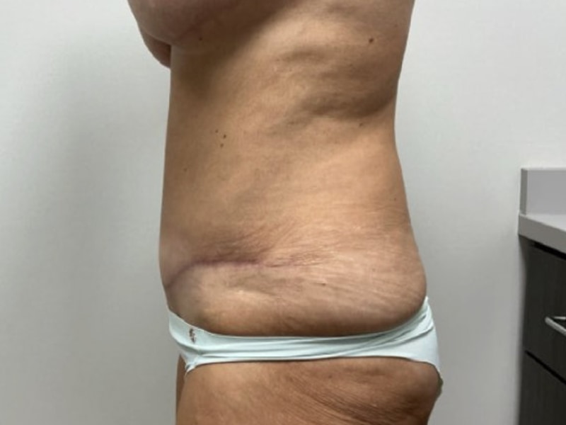 Abdominoplasty Before & After Image
