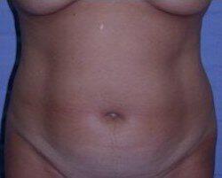 Abdominoplasty Before & After Image