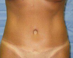 Abdominoplasty Before & After Image