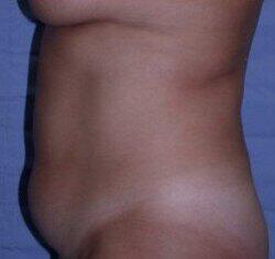 Abdominoplasty Before & After Image