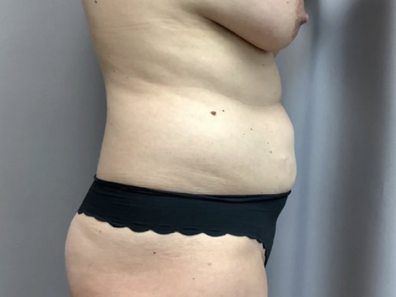 Abdominoplasty Before & After Image