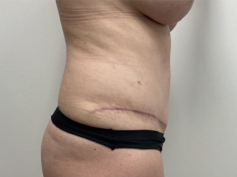 Abdominoplasty Before & After Image