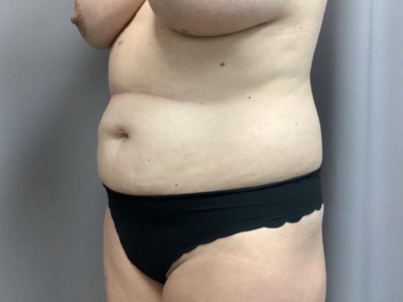 Abdominoplasty Before & After Image