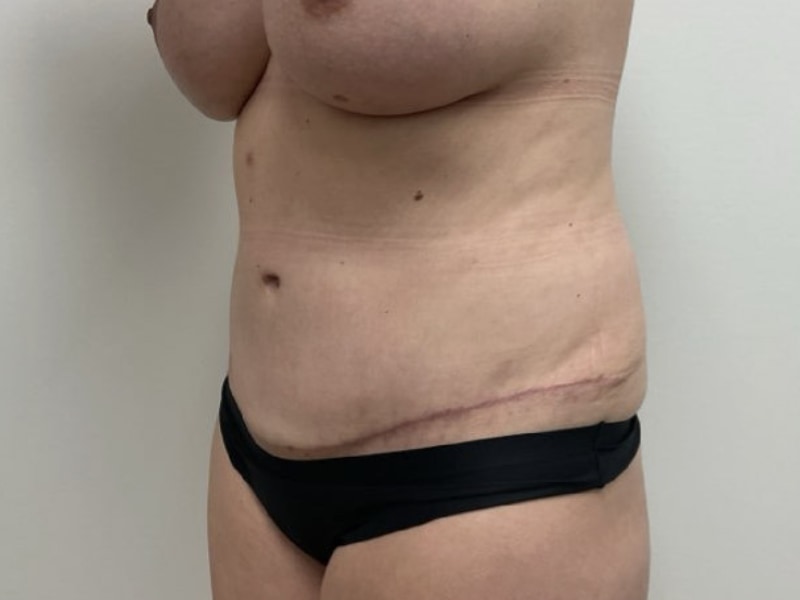 Abdominoplasty Before & After Image