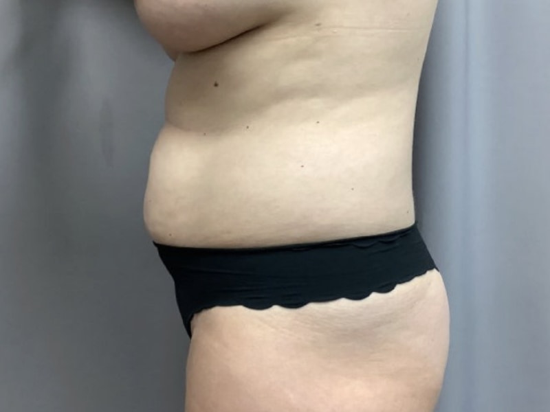 Abdominoplasty Before & After Image