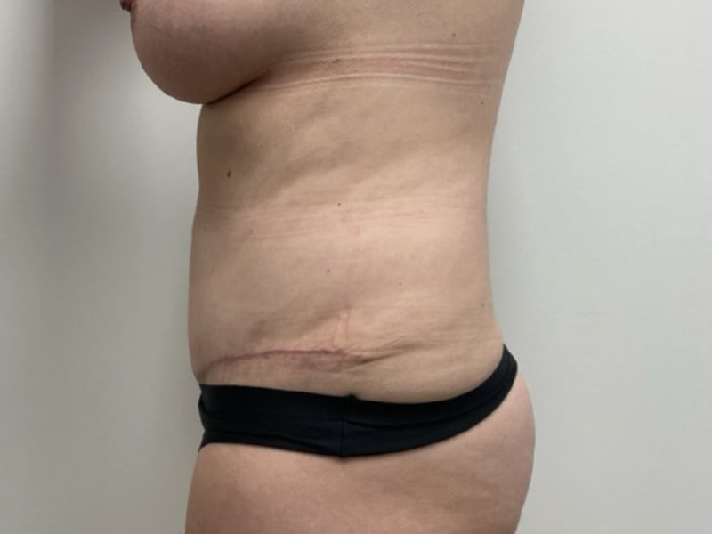 Abdominoplasty Before & After Image