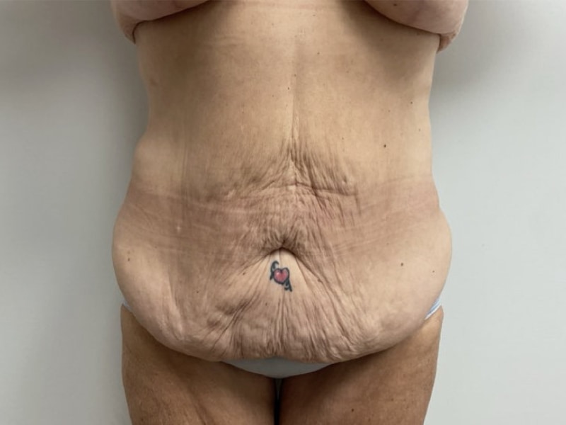 Abdominoplasty Before & After Image
