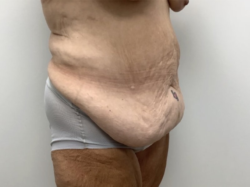 Abdominoplasty Before & After Image