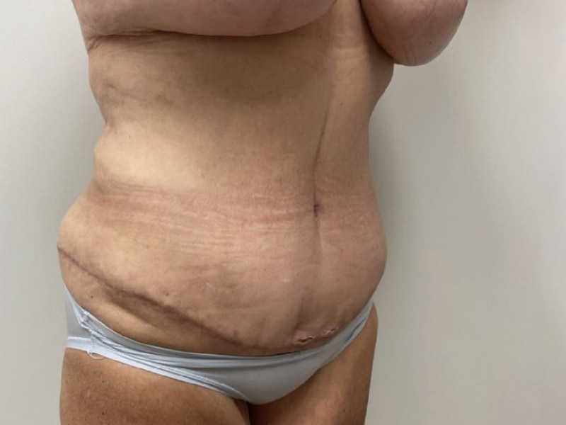 Abdominoplasty Before & After Image
