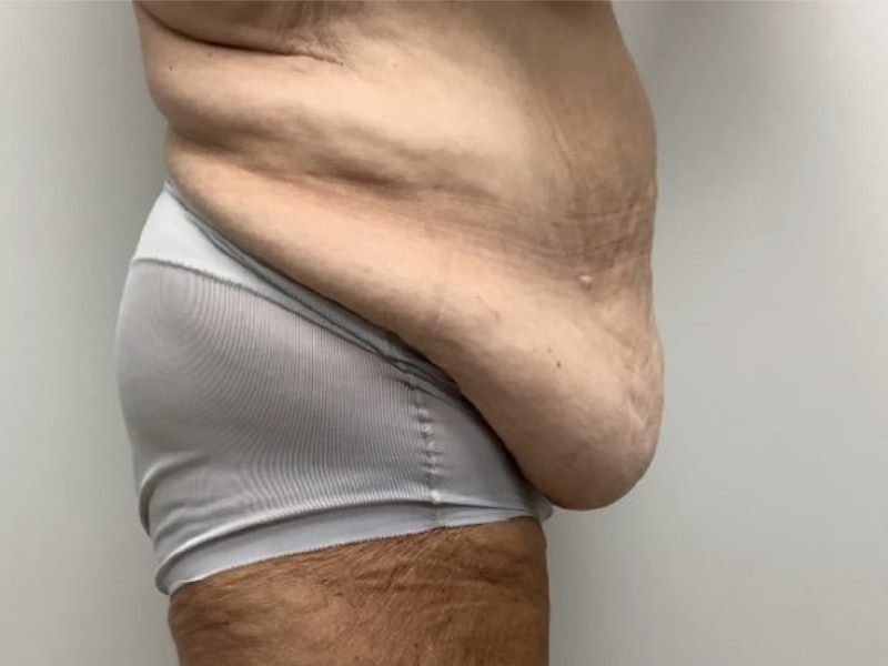 Abdominoplasty Before & After Image