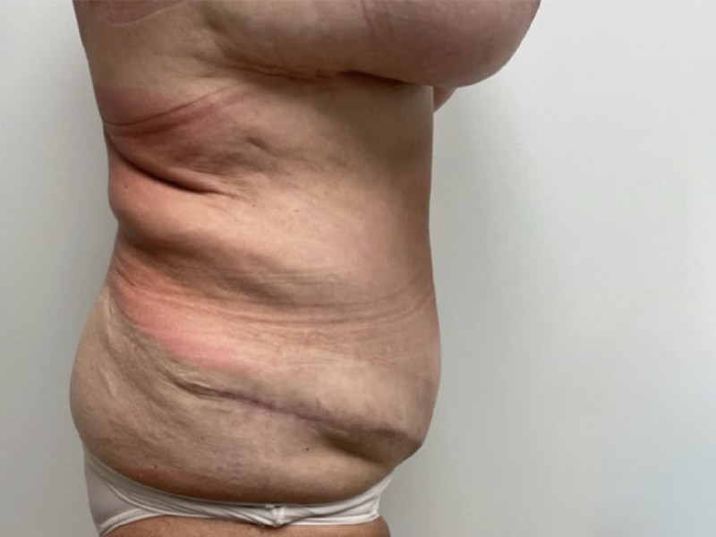 Abdominoplasty Before & After Image