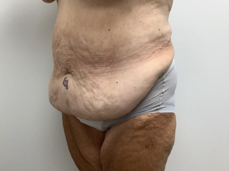 Abdominoplasty Before & After Image