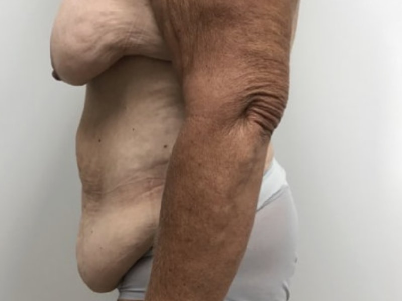 Abdominoplasty Before & After Image