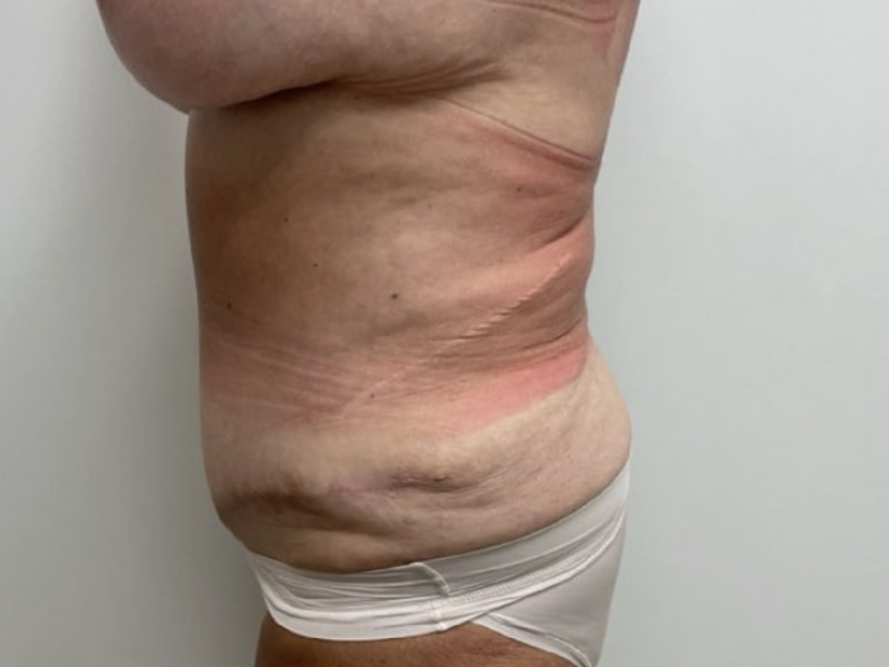 Abdominoplasty Before & After Image