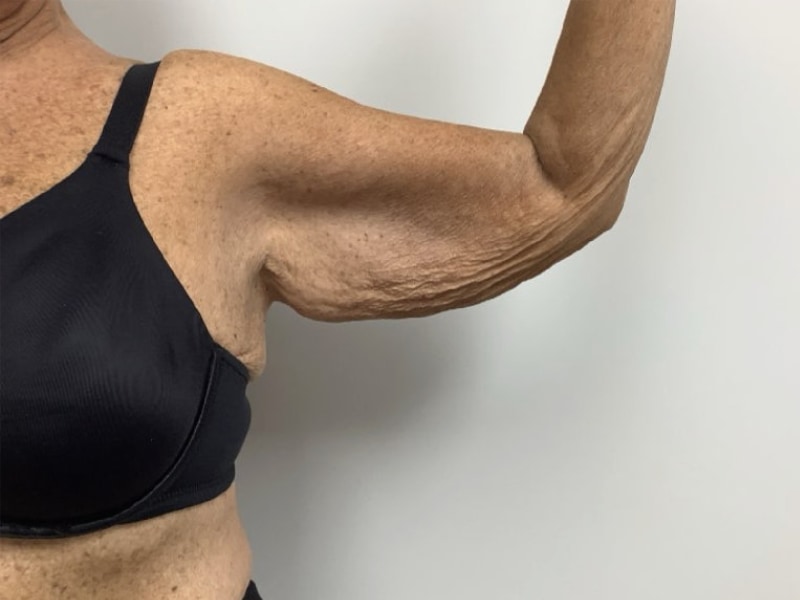 Brachioplasty Before & After Image