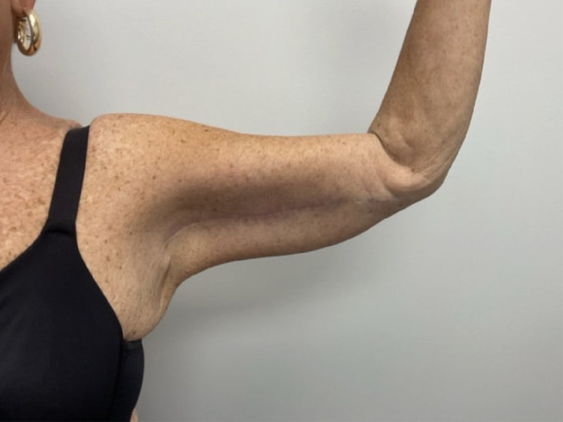 Brachioplasty Before & After Image