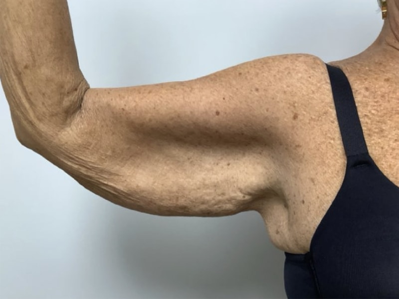 Brachioplasty Before & After Image