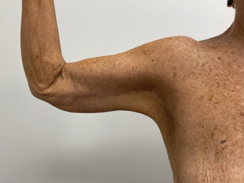 Brachioplasty Before & After Image