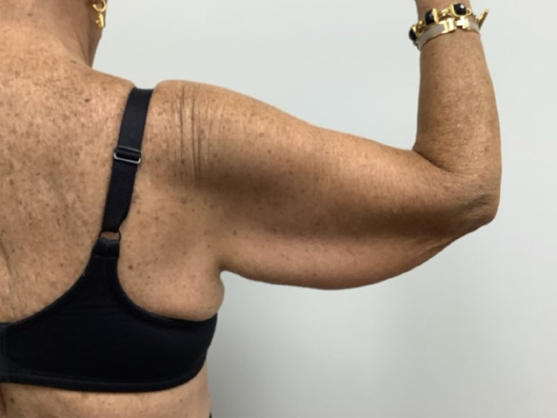 Brachioplasty Before & After Image