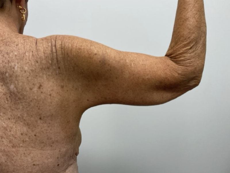 Brachioplasty Before & After Image