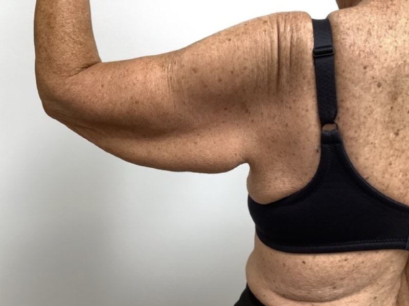 Brachioplasty Before & After Image