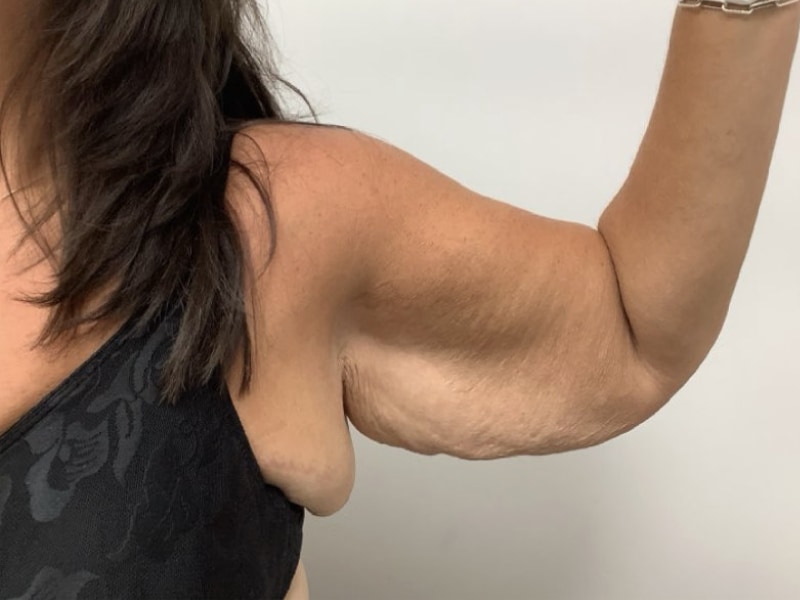 Brachioplasty Before & After Image