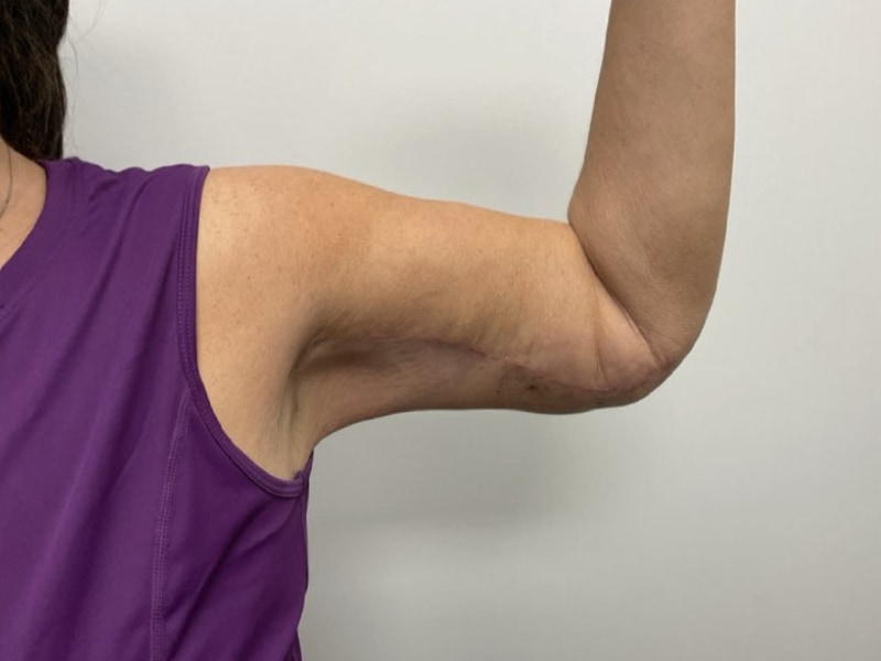 Brachioplasty Before & After Image