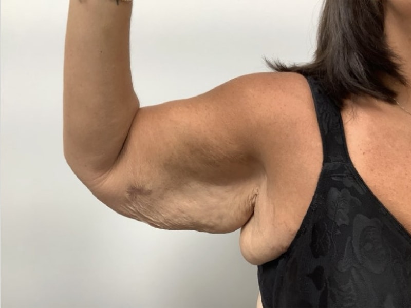 Brachioplasty Before & After Image