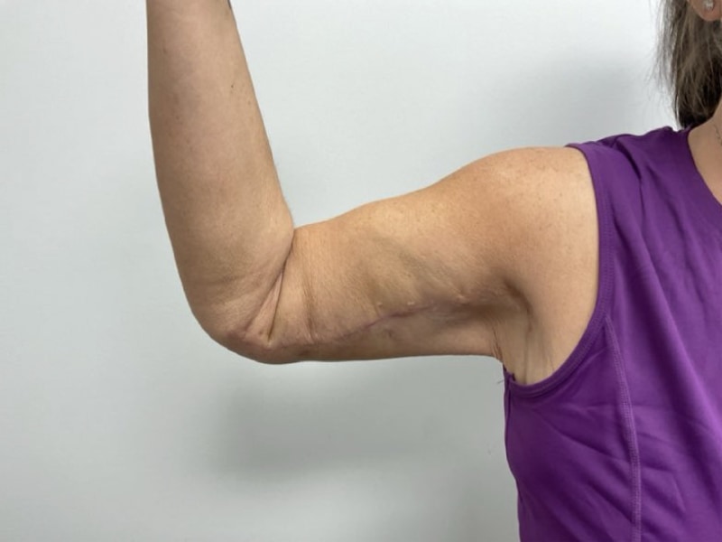 Brachioplasty Before & After Image