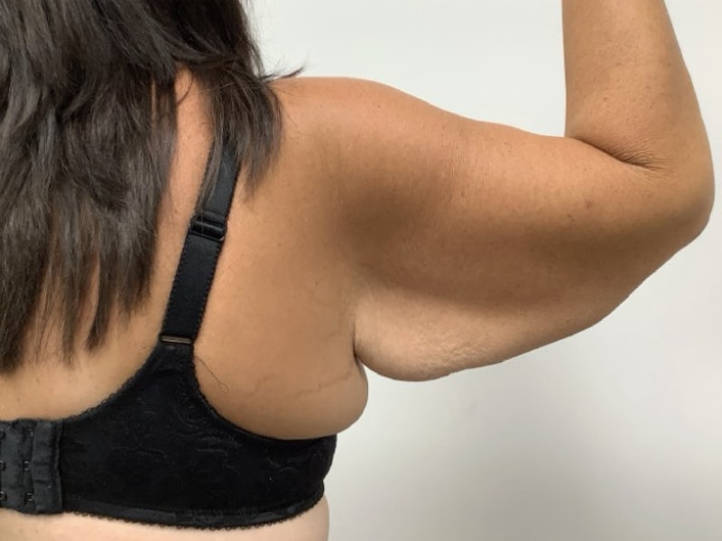 Brachioplasty Before & After Image