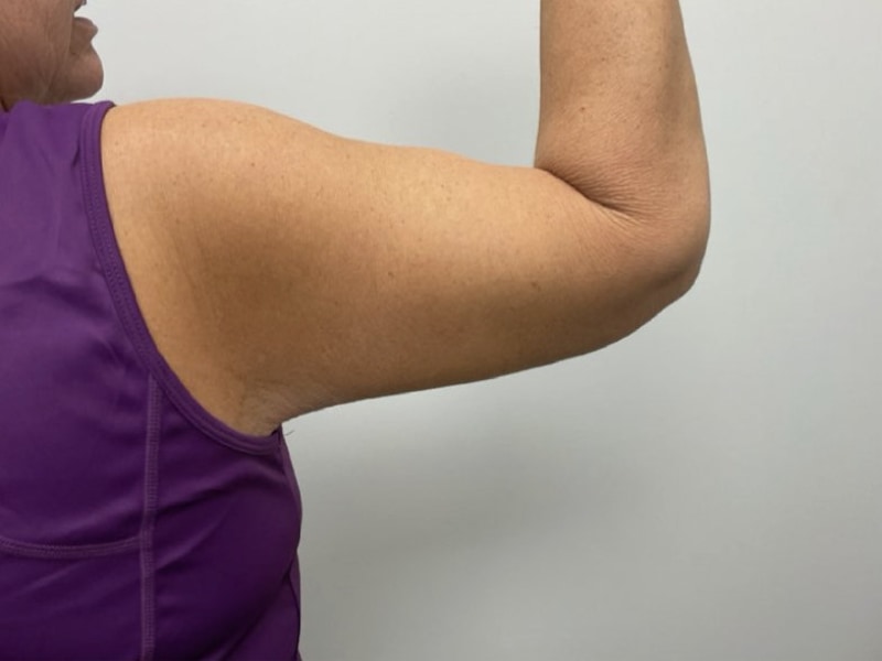 Brachioplasty Before & After Image