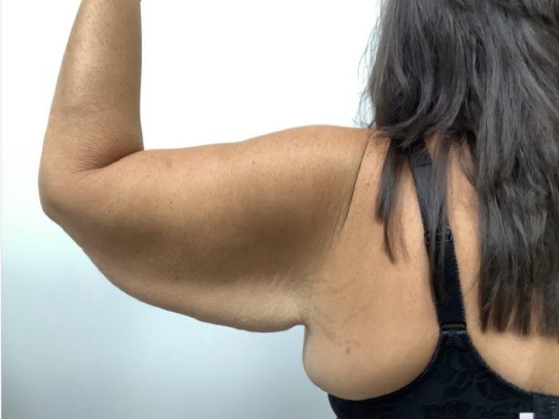 Brachioplasty Before & After Image
