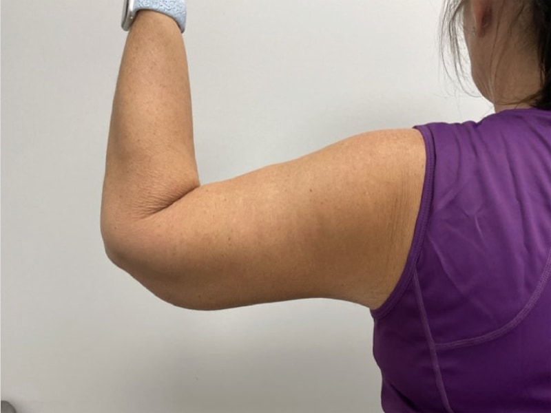Brachioplasty Before & After Image